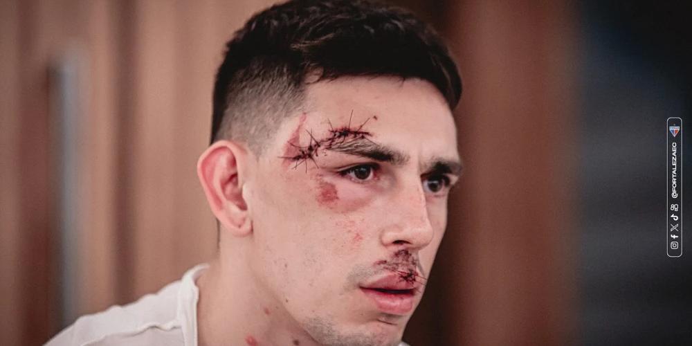 Gonzalo Escobar foi atingido na cabeça por torcedores do Sport e ainda não voltou a jogar (Divulgação/ Fortaleza)