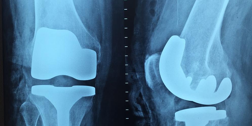 Fratura causada pelo fisioterapeuta ficou provada por meio de radiografia
(PxHere)