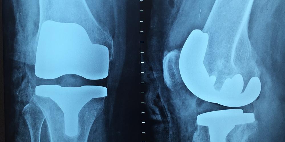 Menina teve uma lesão na perna durante atividade na fisioterapia (PxHere / Reprodução)