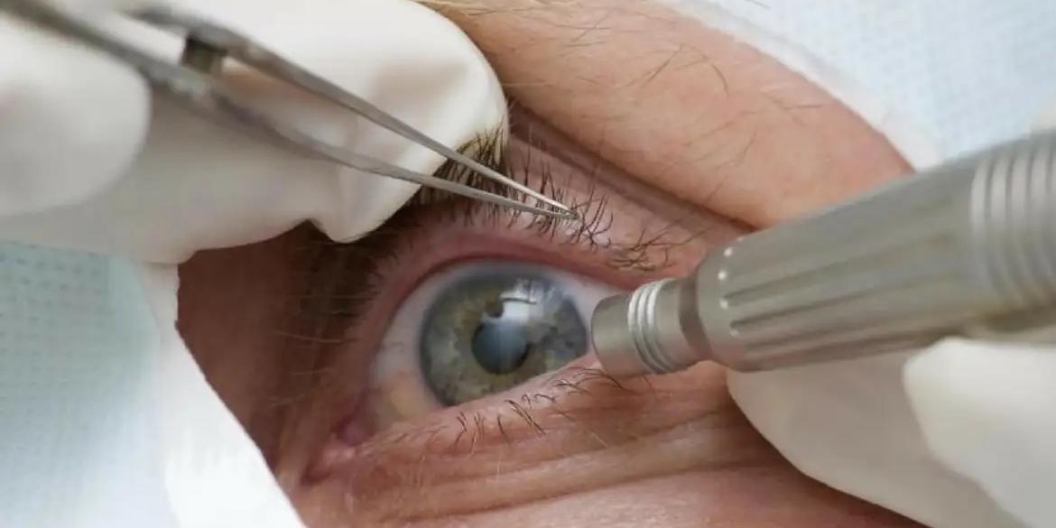 Sem protocolos, casos de infecção ocular pós-cirúrgica podem ocorrer (Pref de Três Barras SC/Divulgação/Direitos Reservados)