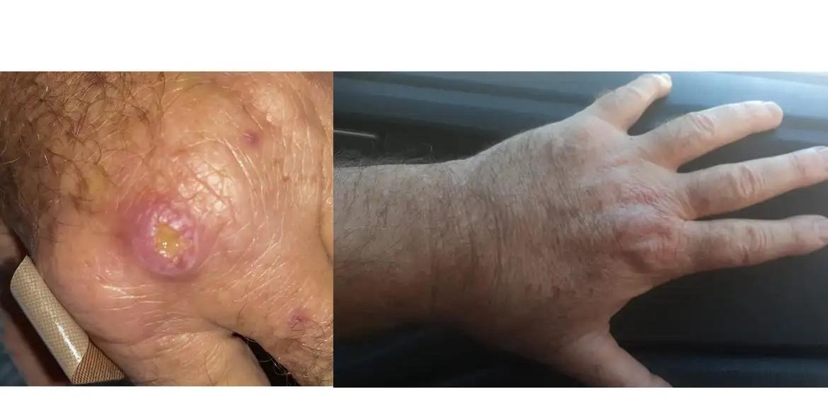Em humanos, o quadro clínico se caracteriza por febre de longa duração, perda de peso, fraqueza, adinamia, hepatoesplenomegalia e anemia, sendo as crianças e idosos os mais suscetíveis ao desenvolvimento da doença (Fernando Correa Losada/Arquivo Pessoal)