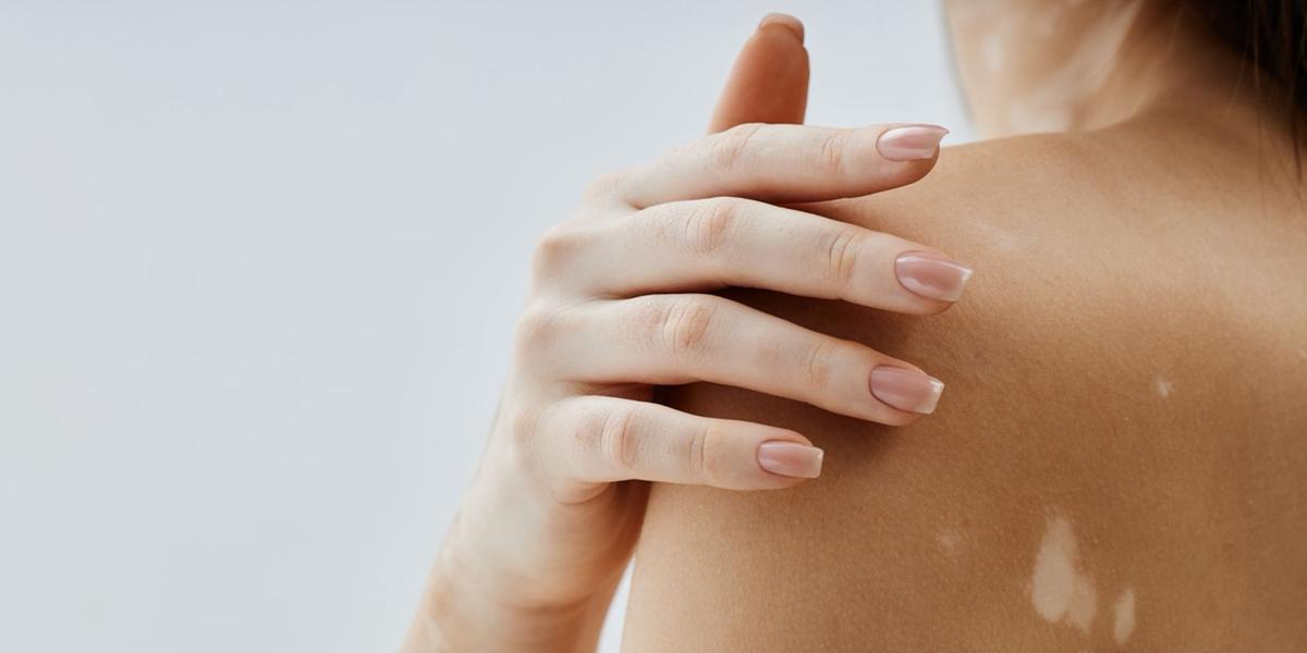 O vitiligo é caracterizado pela destruição dos melanócitos – células responsáveis pela produção de melanina, pigmento que define a cor da pele, cabelos e olhos (Guetty Images)