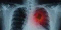 De acordo com o Instituto Nacional de Câncer (Inca), o câncer de pulmão é a quarta neoplasia mais incidente no Brasil