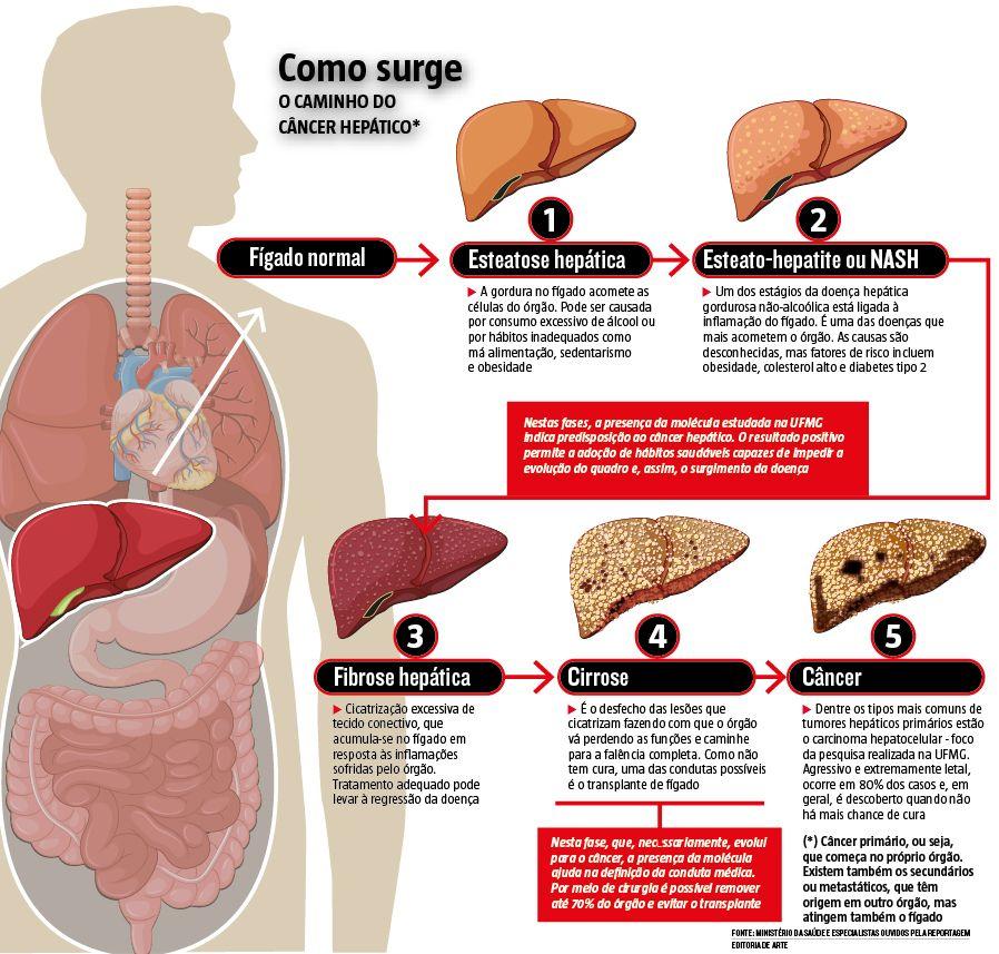 Molécula aponta predisposição a câncer no fígado e permite antecipar cuidados para evitar doença Molécula aponta predisposição a câncer no fígado e permite antecipar cuidados para evitar doença