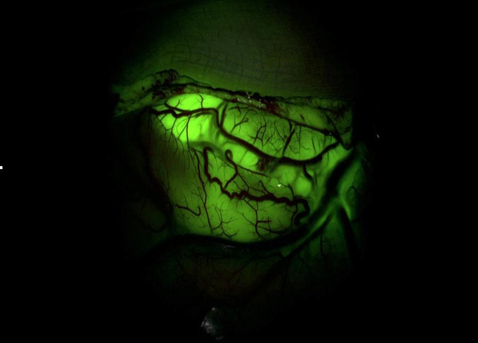 Tecnologia usa fluorescência para visualizar câncer no cérebro, como glioblastoma multiforme (UFMG / Divulgação)