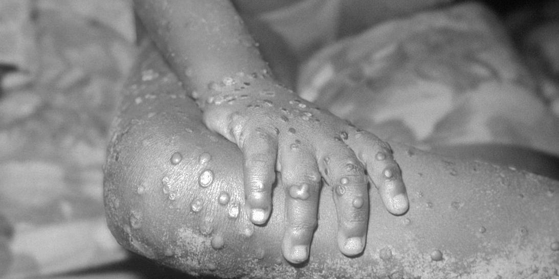 Erupções na pele são características da varíola dos macacos (CDC's Public Health Image Library/Domínio Público)