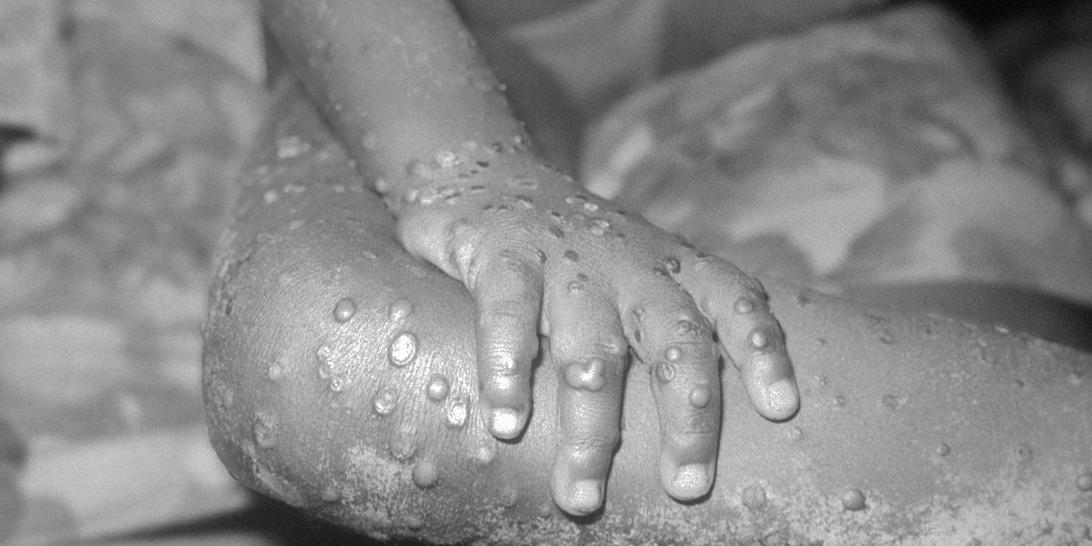 Exames descartam varíola dos macacos em paciente de Uberlândia  (Divulgação/CDC's Public Health Image Library / Domínio Público)