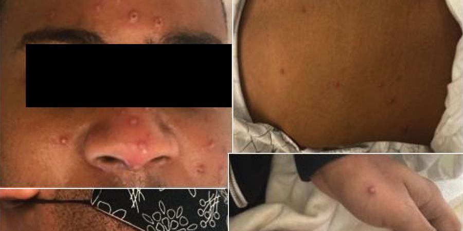 (Varea Costello, Madeleine Sowash, Aahana Gaur et ali / Emerging Infectious Diseases / Reprodução)