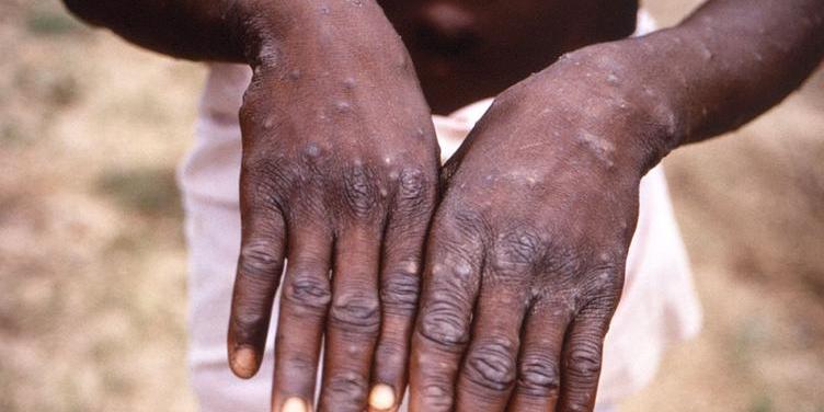 Doença começa com febre, dor de cabeça e dores musculares
(Centers for Disease Control and Prevention/Brian W.J. Mahy)