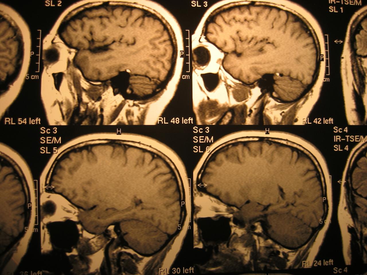 Die Studie besagt, dass Patienten nach der Covid-19-Behandlung monatelang neurologische Symptome haben können