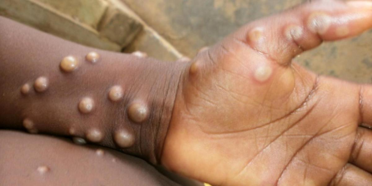 Vírus Monkeypox causa doença de mesmo nome, provocando erupções na pele e infecção parecida com a gripe; lesões geralmente surgem no rosto, antes de se espalharem pelo restante do corpo (Centers for Disease Control and Prevention / Divulgação)