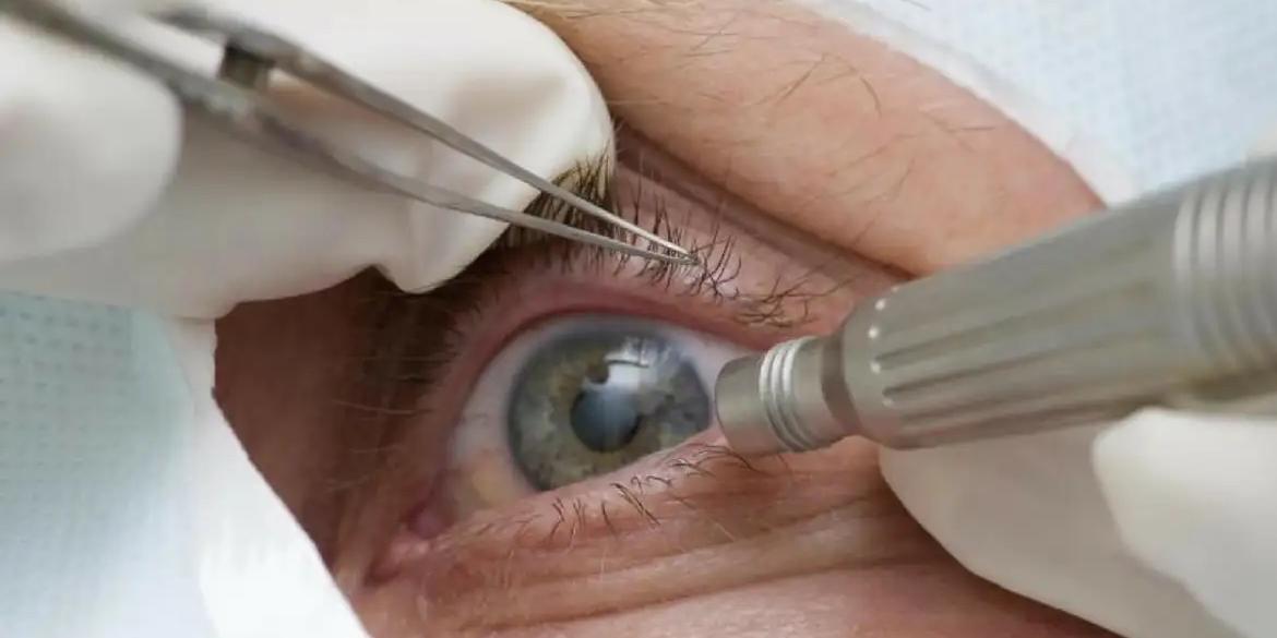 Indicado para pacientes com cegueira permanente ou baixa viso extrema para recuperar a aparncia de um olho normal, procedimento pode causar leses na crnea e infeces graves (Pref de Trs Barras SC/Divulgao)